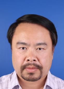 After Hair Transplant&nbsp;Front
